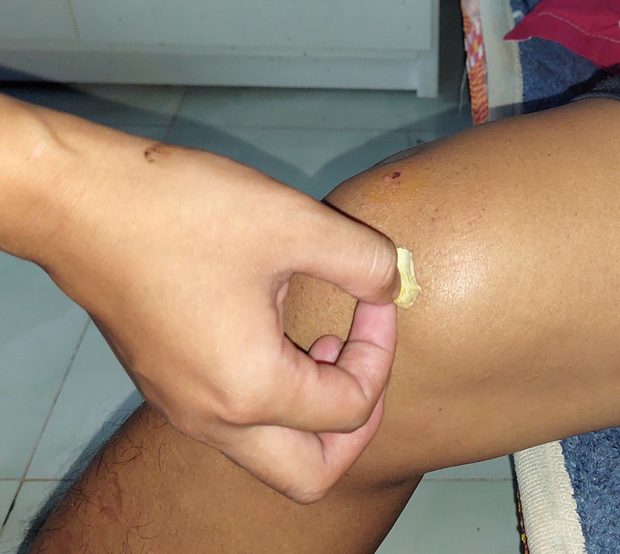 Vì có hiệu quả nên nhiều người dân sinh sống trên dãy Trường Sơn rất tin vào bài thuốc thổi