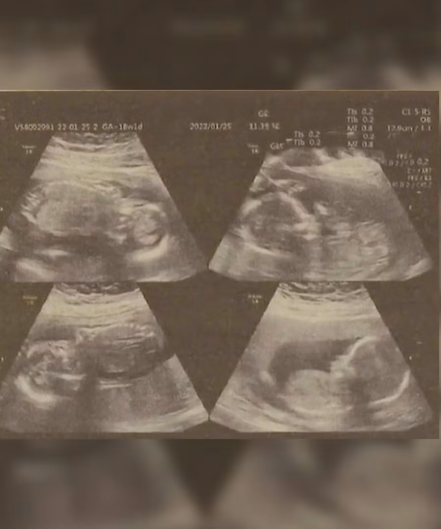  Dù mang thai 4, người phụ nữ 22 tuổi ở Trung Quốc mới chỉ sinh 2 bé. Ảnh chụp màn hình south china morning post