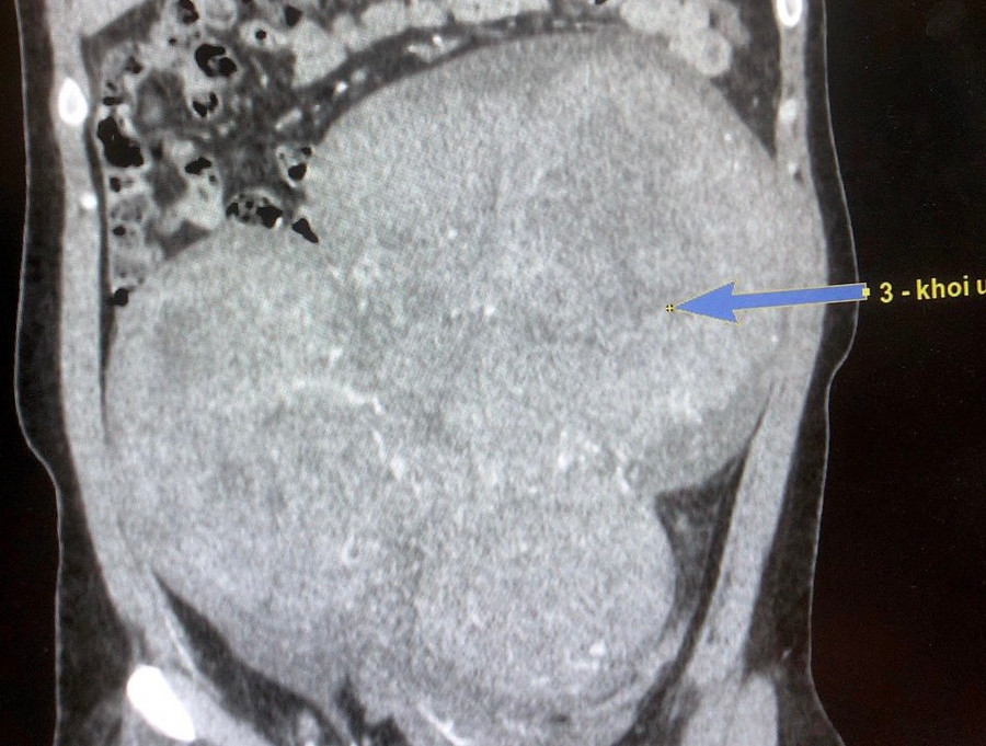  Hình ảnh chụp cắt lớp vi tính ghi nhận bệnh nhân có u to vùng ổ bụng xuất phát từ vùng hạ vị. Ảnh: Đình Tuyển