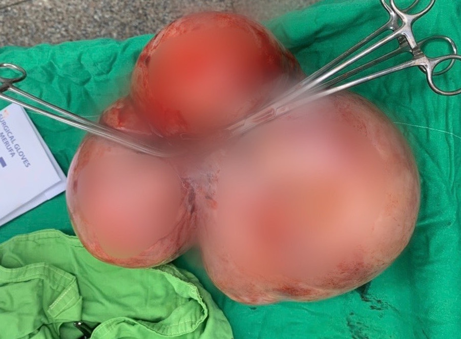 Khối u xơ tử cung nặng 5,5 kg được các bác sĩ bóc tách ra khỏi cơ thể bệnh nhân. Ảnh: Đình Tuyển