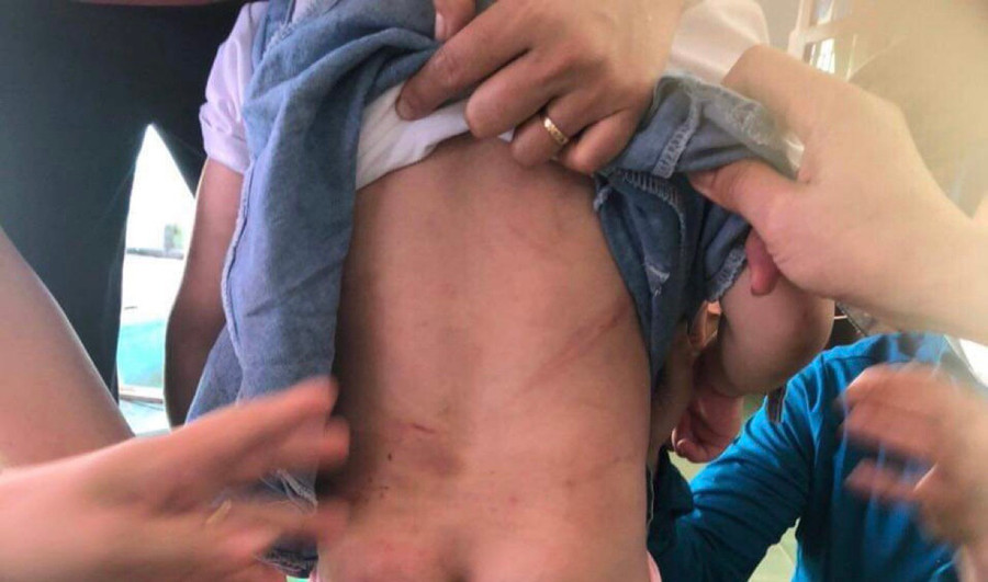 Trên cơ thể của bé gái 4 tuổi có nhiều vết bầm tím do bị đánh. Ảnh: Tân Kỳ Trên cơ thể của bé gái 4 tuổi có nhiều vết bầm tím do bị đánh. Ảnh: Tân Kỳ