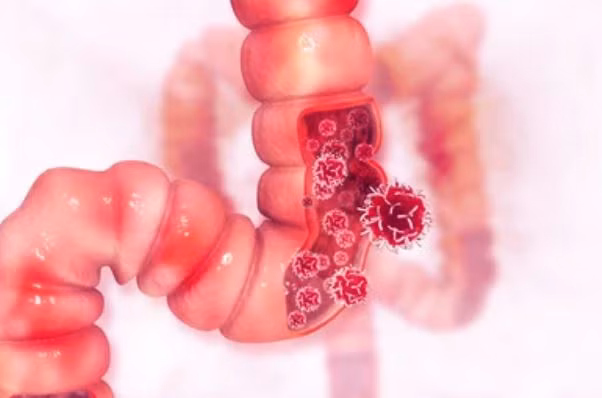 Bệnh nhân ung thư đại trực tràng sau 1 năm điều trị bằng nấm linh chi đã giảm số lượng khối u và kích thước của các khối u trong ruột già. Ảnh: Shutterstock