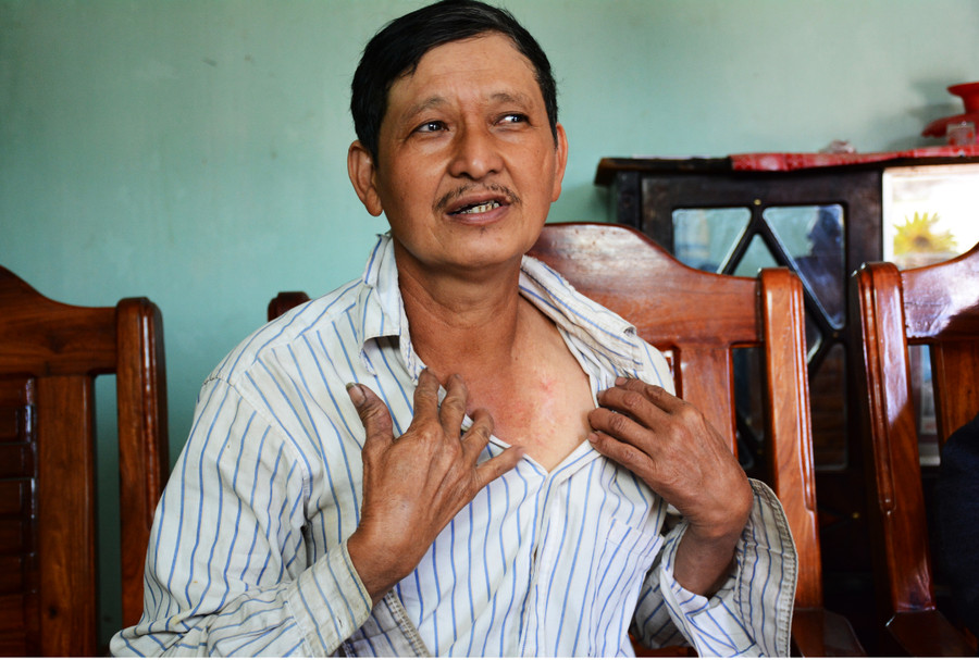Ông Nguyễn Quốc Việt-Thôn Tân lập, xã Ia Khươl-kể về những nhát dao chí mạng của bọn FULRO ngày đó trút lên cơ thể mình. Ảnh: Minh Nguyễn