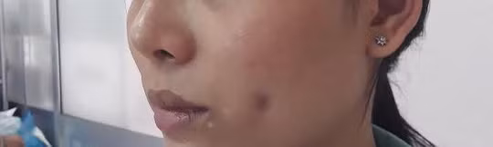 Một phụ nữ bị biến chứng sau phẫu thuật làm đẹp núm đồng tiền