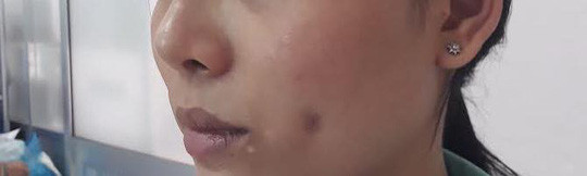 Một phụ nữ bị biến chứng sau phẫu thuật làm đẹp núm đồng tiền