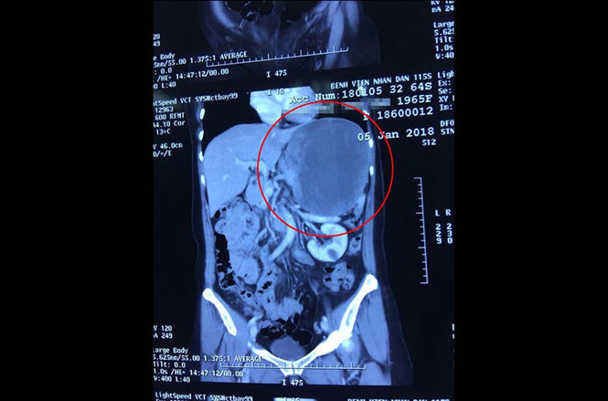  Hình ảnh khối u qua chụp CT scanner
