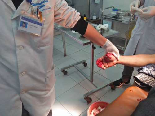 Anh Nguyễn Văn Khương nhập viện trong tình trạng bàn tay phải bị dập, ngón tay cái bị đứt lìa. Anh Nguyễn Văn Khương nhập viện trong tình trạng bàn tay phải bị dập, ngón tay cái bị đứt lìa.