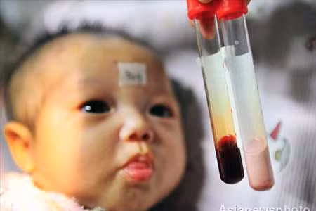 Bé gái mang dòng máu hồng là một trường hợp rất hiếm gặp.