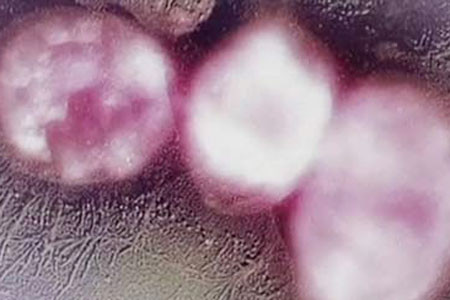 “Siêu vi khuẩn” kháng thuốc có ở Việt Nam ảnh 1