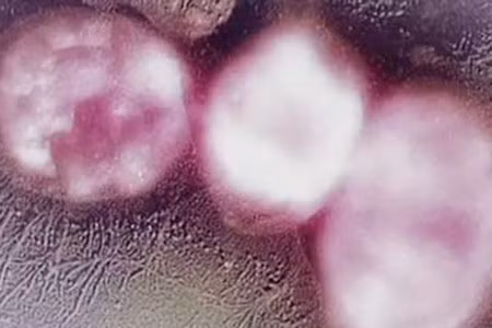 “Siêu vi khuẩn” kháng thuốc có ở Việt Nam ảnh 1