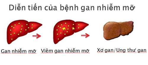Bệnh gan nhiễm mỡ gây viêm gan nhiễm mỡ, xơ gan và ung thư.