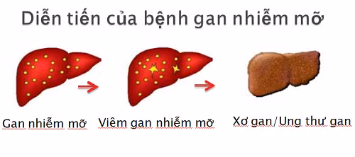 Bệnh gan nhiễm mỡ gây viêm gan nhiễm mỡ, xơ gan và ung thư.