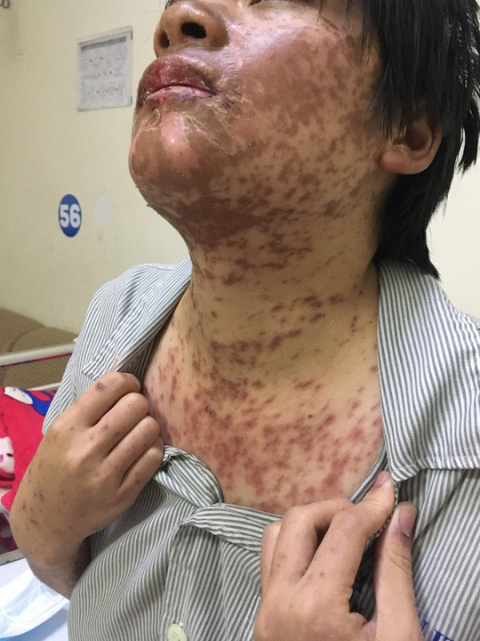  Các vết mẩn nổi khắp người cô gái