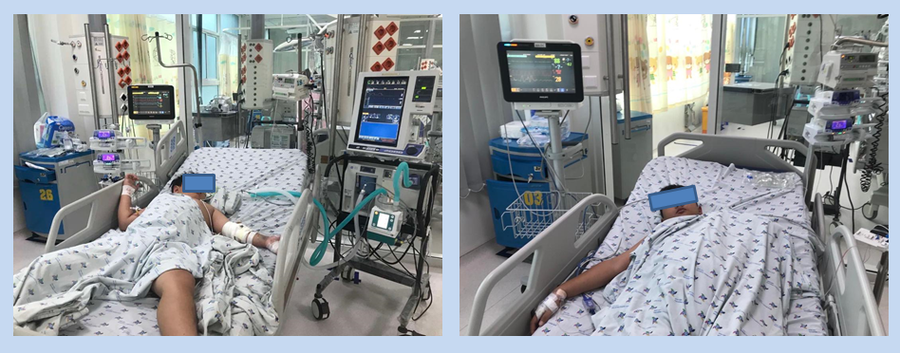  Hai trẻ nam 11 tuổi Long An và Bến Tre sốc sốt xuất dengue nặng thở máy không xâm nhập. Ảnh: BSCC