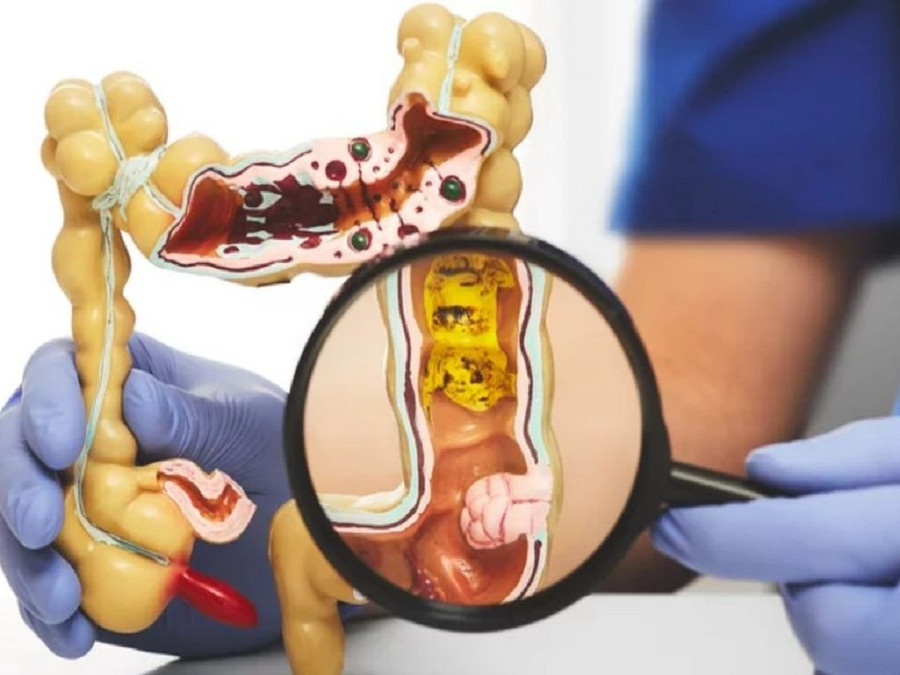 Tầm soát và phát hiện sớm ung thư đại trực tràng có thể giúp tăng khả năng trị khỏi cho người mắc. Ảnh: SHUTTERSTOCK Tầm soát và phát hiện sớm ung thư đại trực tràng có thể giúp tăng khả năng trị khỏi cho người mắc. Ảnh: SHUTTERSTOCK