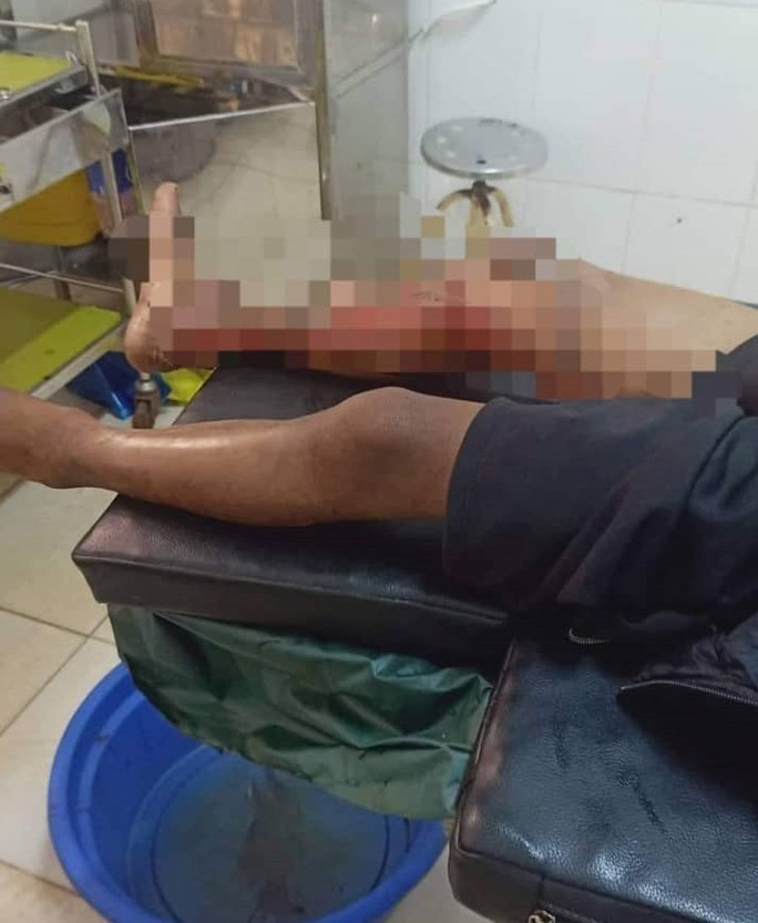 Chân phải của cháu bé bị bỏng nặng, nguy cơ hoại tử Chân phải của cháu bé bị bỏng nặng, nguy cơ hoại tử