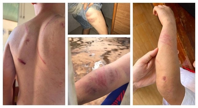 Vết bầm trên người cháu A. do bên ngoại chụp lại. Ảnh nguồn TPO Vết bầm trên người cháu A. do bên ngoại chụp lại. Ảnh nguồn TPO