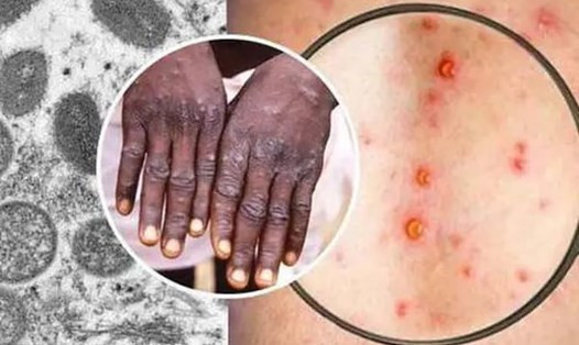 Tổ chức Y tế Thế giới (WHO) đã tuyên bố sự bùng phát bệnh đậu mùa khỉ là tình trạng khẩn cấp quốc tế về y tế công cộng. Ảnh nguôn internt