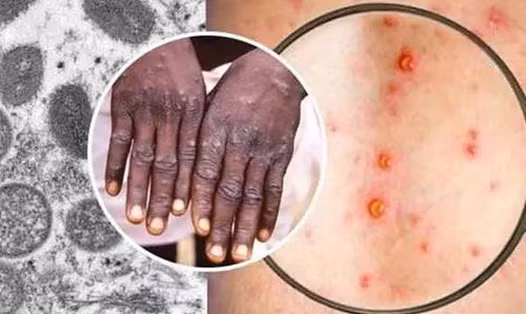 Tổ chức Y tế Thế giới (WHO) đã tuyên bố sự bùng phát bệnh đậu mùa khỉ là tình trạng khẩn cấp quốc tế về y tế công cộng. Ảnh nguôn internt