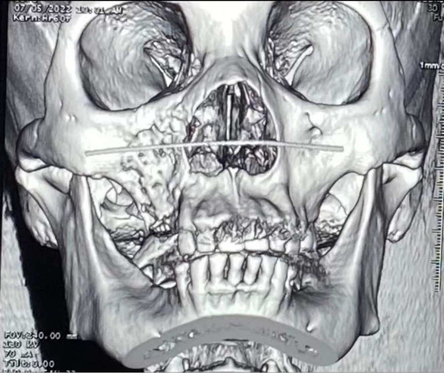 Một ca hoại tử xương hàm được điều trị tại một bệnh viện ở TP.HCM. Ảnh: CTV Một ca hoại tử xương hàm được điều trị tại một bệnh viện ở TP.HCM. Ảnh: CTV