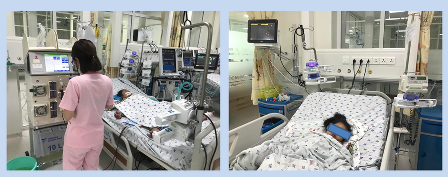  Trẻ Ph.N.Th.K (4 tuổi) sốc sốt xuất dengue nặng, suy đa cơ quan được lọc máu liên tục. Ảnh: BSCC