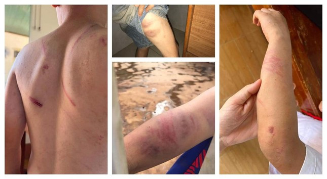 Những vết thương trên người cháu A. do phía bên ngoại chụp lại Những vết thương trên người cháu A. do phía bên ngoại chụp lại