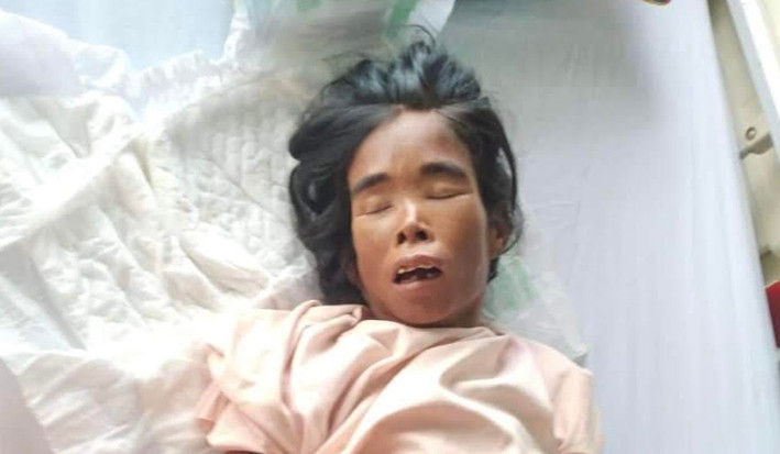 Bệnh nhân Nhui hiện điều trị ở Khoa Nội tổng hợp (Bệnh viện Đa khoa tỉnh). Ảnh Bệnh viện cung cấp Bệnh nhân Nhui hiện điều trị ở Khoa Nội tổng hợp- Bệnh viện Đa khoa tỉnh. Ảnh Bệnh viện cung cấp