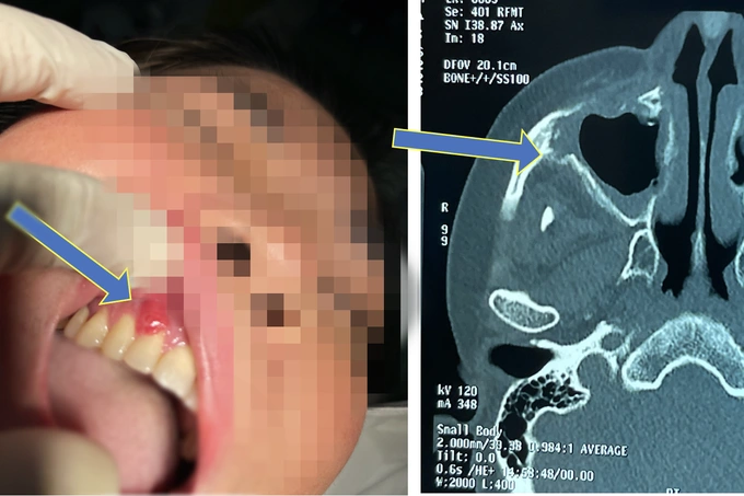 Một bệnh nhân mắc cốt tủy viêm xương. Ảnh bệnh viện cung cấp Một bệnh nhân mắc cốt tủy viêm xương. Ảnh bệnh viện cung cấp