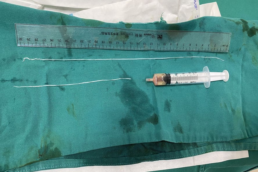 Hình ảnh con giun hiếm kí sinh trong người bệnh nhân. Ảnh: BVCC