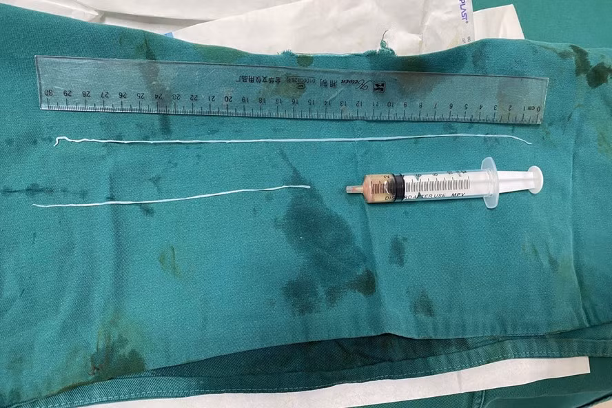 Hình ảnh con giun hiếm kí sinh trong người bệnh nhân. Ảnh: BVCC