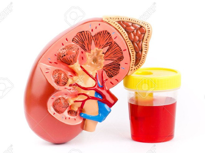 Máu trong nước tiểu có thể đến từ thận, cũng có thể từ các phần khác của đường tiết niệu ẢNH MINH HỌA: SHUTTERSTOCK