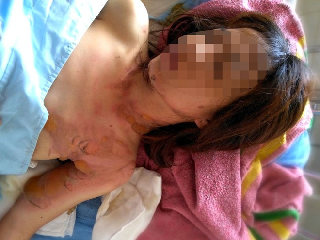 Chị D. bị bỏng nặng đang điều trị tại Bệnh viện II Lâm Đồng ẢNH: TRÙNG DƯƠNG