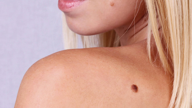  Nốt ruồi khỏe mạnh có hình dạng khá đối xứng và có cạnh mịn, đồng nhất, trong khi một khối u ác tính có nhiều khả năng có đường viền lởm chởm, không đều - Ảnh minh họa: Shutterstock