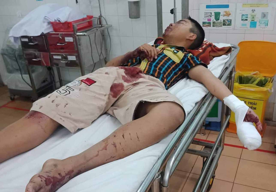 Cháu Hiếu bị thương nặng do đốt pháo. Ảnh: Văn Ngọc