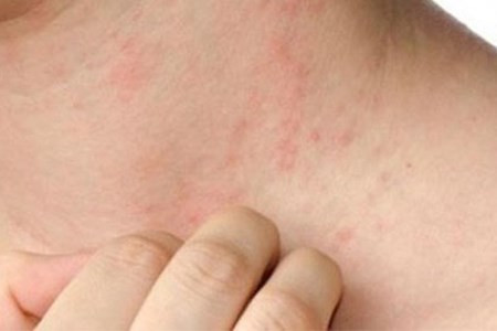 Bệnh xã hội chủ yếu lây qua đường tình dục.