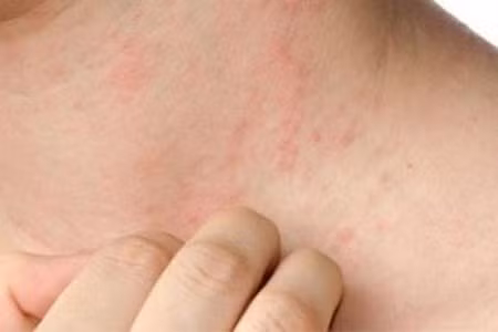 Bệnh xã hội chủ yếu lây qua đường tình dục.