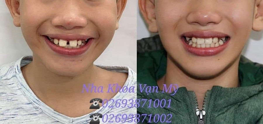 Sau chỉnh nha, nhiều trẻ đã tự tin hơn với hàm răng đều, đẹp (ảnh Nha khoa Vạn Mỹ cung cấp).