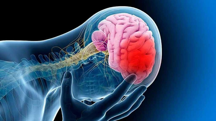 Đột quỵ là một trong những căn bệnh đáng sợ nhất trên thế giới. Ảnh: Shutterstock