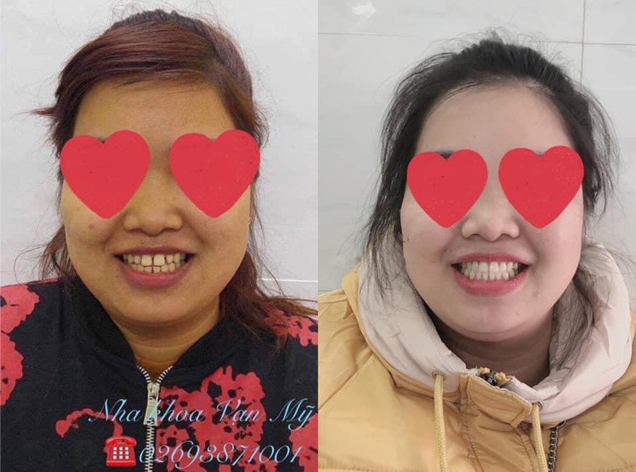 Nhiều người tự tin hơn với nụ cười của mình sau chỉnh nha tại Nha khoa Vạn Mỹ. 