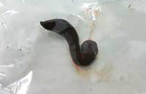 Con đĩa dài hơn 5 cm được gắp ra khỏi thanh, khí quản của cháu M.