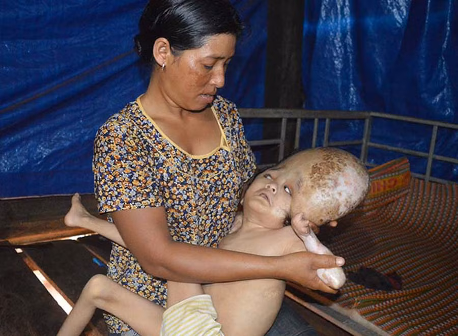  Chị Rơ Châm Bel và con gái 11 tuổi bị não úng thủy. Ảnh. Đ.Y