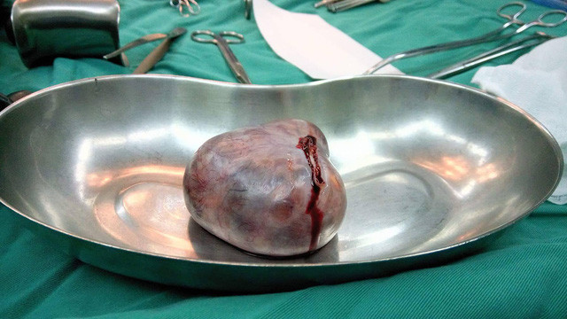 Khối u quái bì buồng trứng được lấy ra khỏi cơ thể người bệnh. Tiếp đó bệnh nhân trải qua gần 5 tháng điều trị đã hồi phục hoàn toàn. Ảnh: BS cung cấp. Khối u quái bì buồng trứng được lấy ra khỏi cơ thể người bệnh. Tiếp đó bệnh nhân trải qua gần 5 tháng điều trị đã hồi phục hoàn toàn. Ảnh: BS cung cấp.