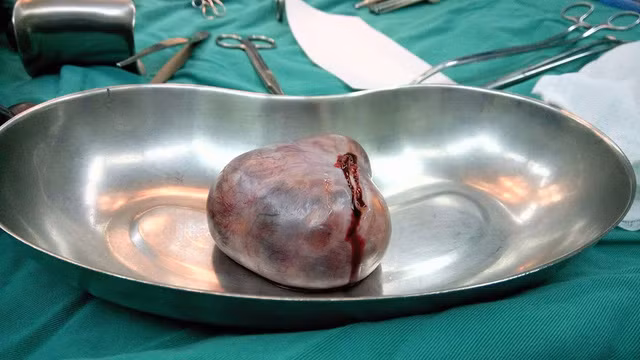 Khối u quái bì buồng trứng được lấy ra khỏi cơ thể người bệnh. Tiếp đó bệnh nhân trải qua gần 5 tháng điều trị đã hồi phục hoàn toàn. Ảnh: BS cung cấp.