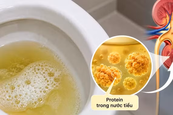Thận yếu: Bác sĩ dặn đừng bỏ qua dấu hiệu đầu tiên này