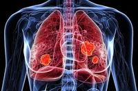 Thuốc Datroway được FDA chấp thuận trong điều trị ung thư phổi không tế bào nhỏ. (Ảnh: Pharmaceutical-technology.com)