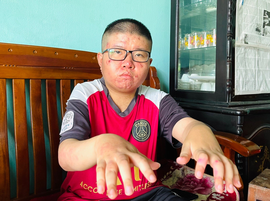 Hàng ngày, Nguyên phải chống chọi với căn bệnh viêm khớp thiếu niên hệ thống. Ảnh: T.D 80b7dc1645a8cdf694b9.jpg