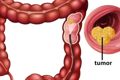 Loại quả ngon ngọt được phát hiện có khả năng ngăn chặn ung thư đại trực tràng