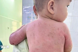 Bé trai 2 tuổi bị bỏng 60% được cứu sống nhờ ghép da từ mẹ