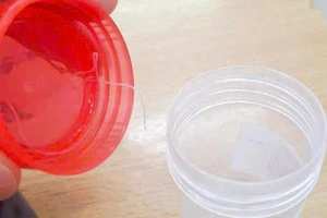 Ký sinh trùng 10 cm sống trong mắt bệnh nhân