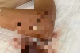 Truy tố giám đốc công ty chém chủ nợ gây thương tích